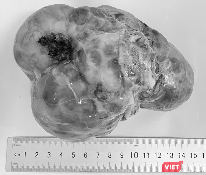 Khối u lấy từ ổ bụng của bệnh nhi được ê kíp bác sĩ Bệnh viện Phụ sản - Nhi Đà Nẵng thực hiện.