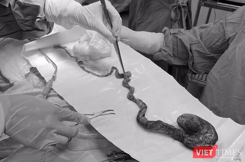 Bóc bỏ búi tóc khổng lồ chiếm hết dạ dày và kéo dài xuống ruột non vừa được các bác sĩ Bệnh viện Phụ sản - Nhi Đà Nẵng lấy ra từu dạ dày bệnh nhi 6 tuổi.