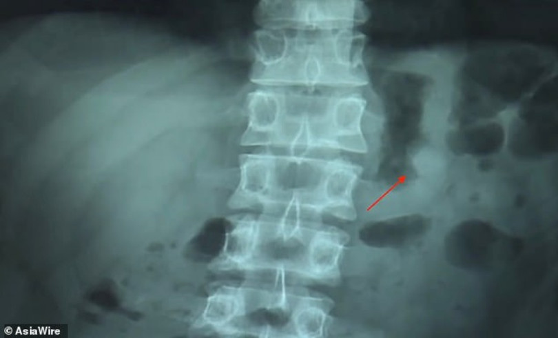 phim chụp X-quang cho thấy một bên tai nghe AirPods nằm trong cơ thể (ảnh: Asia Wire)