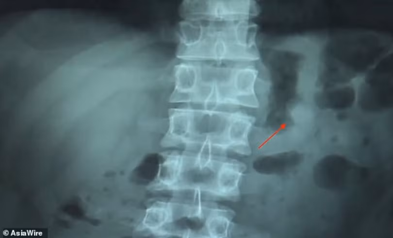 phim chụp X-quang cho thấy một bên tai nghe AirPods nằm trong cơ thể (ảnh: Asia Wire)