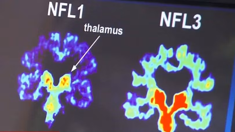 Phân tích não bộ của các bác sĩ phẫu thuật. Ảnh: Futurism. 