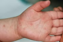 Từ đầu năm đến nay đã có hơn 7.200 ca mắc tay chân miệng, tăng 241,3% so với cùng kỳ năm 2025.