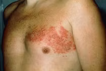 Zona tấn công người bệnh mạn tính: nguy cơ tăng gần 40%, đau kéo dài ám ảnh