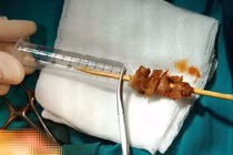 Bé gái suýt mù mắt vì bị ngã khi cầm que thịt nướng