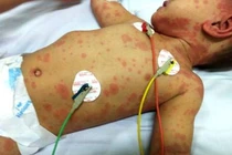 Não mô cầu gia tăng, nguy hiểm khi dễ nhầm với cúm, tỷ lệ tử vong cao