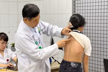 Phát hiện muộn, nhiều trẻ vẹo cột sống nặng bị biến dạng lồng ngực, mất cơ hội điều trị tối ưu