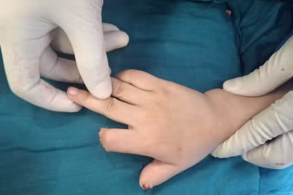 Tai nạn xe điện tự chế, bé 5 tuổi đứt lìa 2 ngón tay 