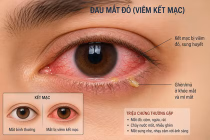 Bệnh đau mắt đỏ gia tăng, Bộ Y tế cảnh báo 7 điều tuyệt đối không được chủ quan 