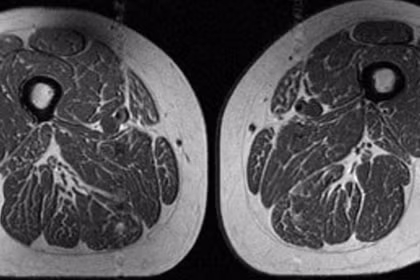 Hình ảnh chụp cộng hưởng từ (MRI) vùng đùi của một phụ nữ. Chế độ ăn của người này có đến 87% là thực phẩm chế biến sẵn. Ảnh: Hội X quang Bắc Mỹ.