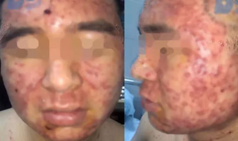 Sử dụng thuốc nam, nam thanh niên bị mụn chi chít. (Ảnh bệnh viện cung cấp) 