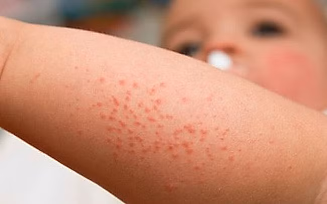 Nốt ban đỏ biểu hiện sốt xuất huyết ở trẻ (Ảnh minh hoạ) Nốt ban đỏ biểu hiện sốt xuất huyết ở trẻ (Ảnh minh hoạ)