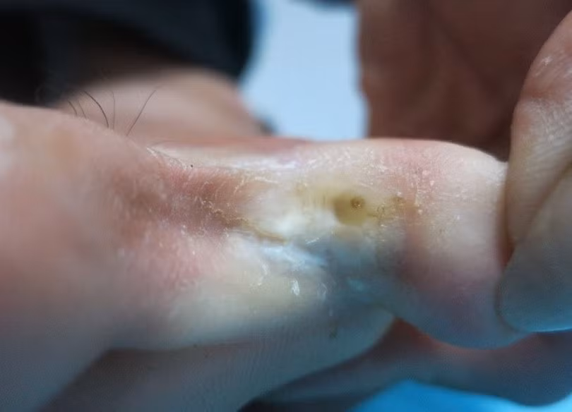 Một bệnh nhân bị nấm kẽ chân (Ảnh: BS. Lê Thị Mai) Một bệnh nhân bị nấm kẽ chân (Ảnh: BS. Lê Thị Mai)
