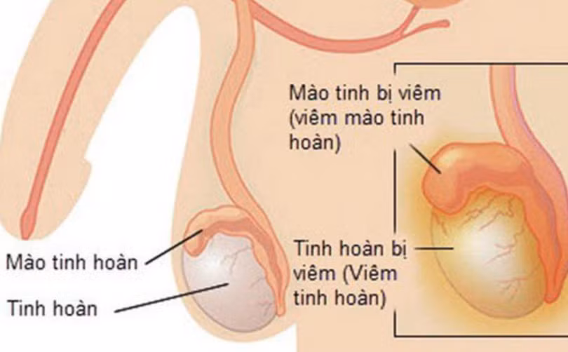 Hình ảnh viêm mào tinh hoàn và viêm tinh hoàn (Ảnh - Khoa Nam học và Y học giới tính, Bệnh viện Đại học Y Hà Nội) Hình ảnh viêm mào tinh hoàn và viêm tinh hoàn (Ảnh - Khoa Nam học và Y học giới tính, Bệnh viện Đại học Y Hà Nội)