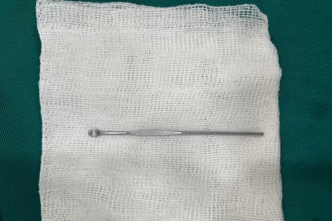 Cậu bé 14 tuổi nhập viện, bác sĩ phát hiện dị vật dài 12 cm trong niệu đạo